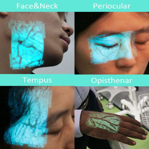 VS400 showing veins face neck periocular tempus 
