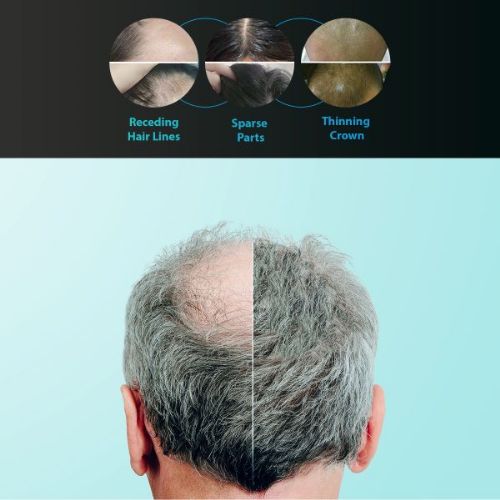 Hair problems that can be treated with the Cold Laser Therapy Hair Regrowth Helment LLLT