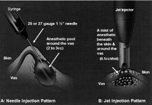 Basic representation of the anesthetic procedure