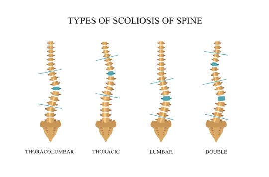 All types of scoliosis the D.B.S. treats